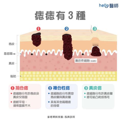 臉上多了痣|痣變大、痣多或長毛會變皮膚癌？認識痣的形成與原因